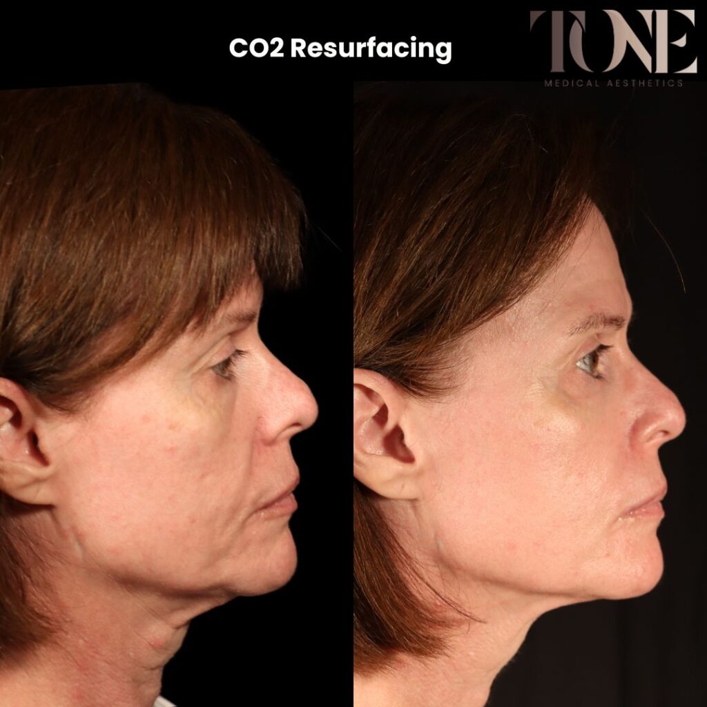 CO2 Laser Resurfacing before and after