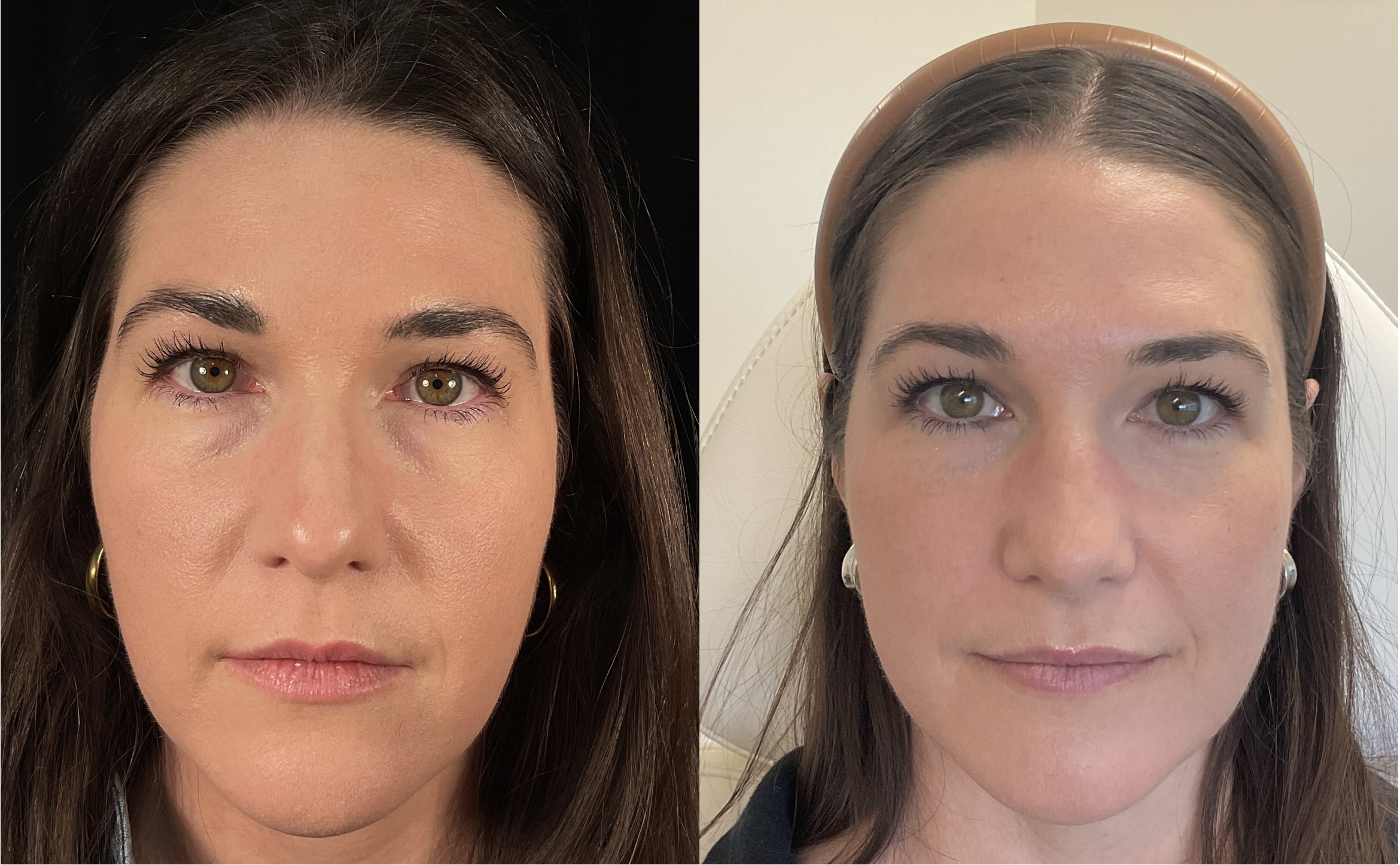 under eye rejuvenation using PRF