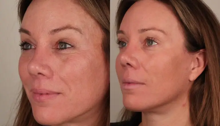 Microneedling before and after for fine lines and skin health