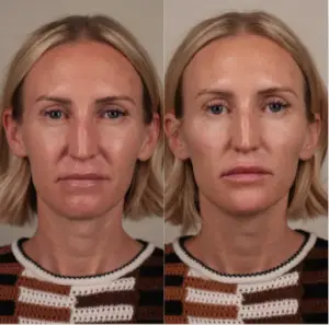 dermal filler before & after