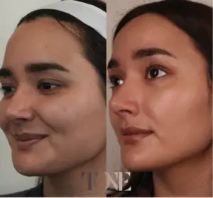 Microneedling before and after