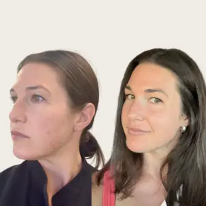 LaseMD Ultra before and after photo