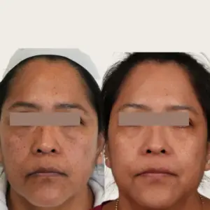 LaseMD Ultra before and after for dark pigment spots